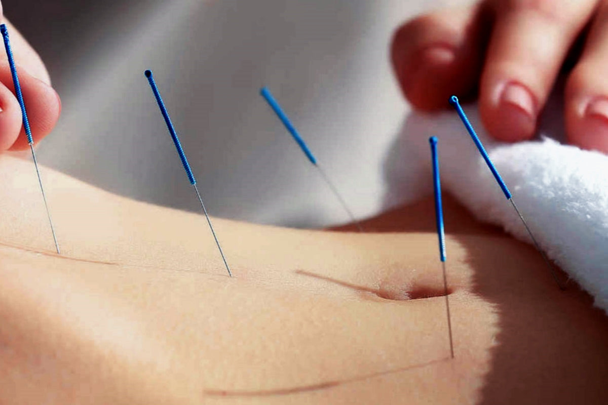 The woman is getting acupuncture.